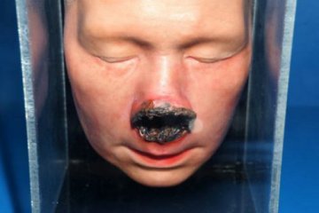 梅毒三期的面部