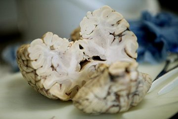 揭秘人脑解剖全过程