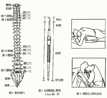 钩活术治疗腰椎间盘突出症