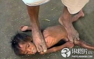 全球最不可思议的“治病”怪招 泰国用蛆治病