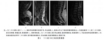 空军总医院专家顾建文谈脊柱裂脊髓脊膜膨出