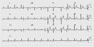 房性早搏Atrial Premature Beat