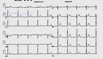 W-P-W综合症Wolff-Parkinson-White syndrome