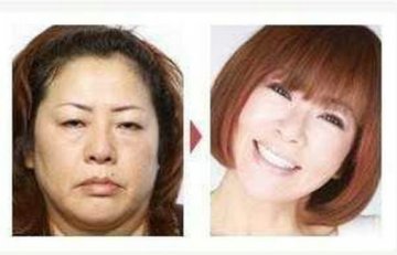 日本整形医院惊悚整容对比照大曝光