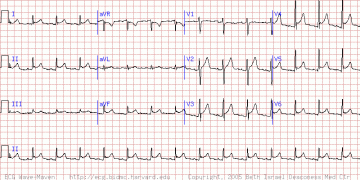 急性心包炎 Pericarditis