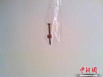 男婴误吞4厘米长水泥钉 手术并成功取出