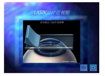 lasik10