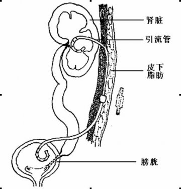 新技术让患者告别肾造瘘