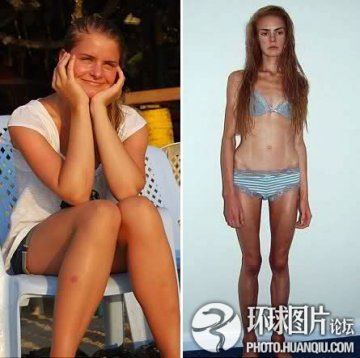 盘点：惨不忍睹的减肥后遗症