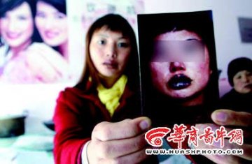 少妇文唇后唇变形夫妻关系破裂图