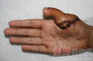 女孩手指被蛇咬致坏死 医生移植脚趾做手指