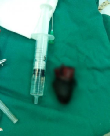 男子做包皮手术致阴茎被烤熟 生殖器被切