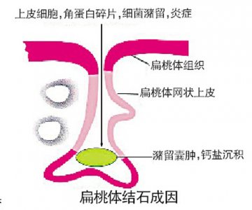 扁桃体也能长结石