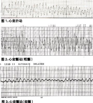 心室扑动和颤动