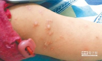 台湾1周三万幼儿感染肠病毒 出现全身性大水泡