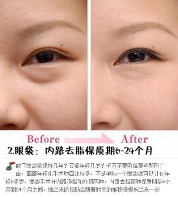 整形手术保质期大揭秘