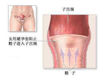 女性避孕套的避孕机制