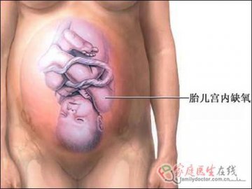 医学图解：剖腹产手术全过程