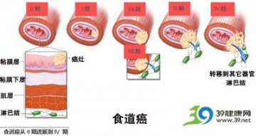 食管癌是“烫”出来的？