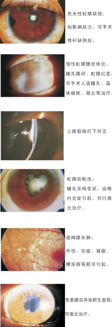先天性虹膜缺损、慢性虹膜睫状体炎、瞳孔膜闭、虹膜红变、虹膜后粘连、视网膜水肿、色素膜炎并发新生血管