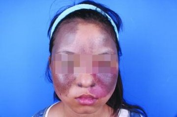 14岁女孩全身长满胎记 随年龄增长慢慢扩散