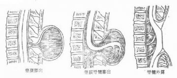 脊柱裂