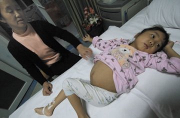 6岁苗族女孩患怪病肚子鼓起如皮球