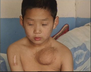 小诊所非法接生致孕妇死亡婴儿脑瘫
