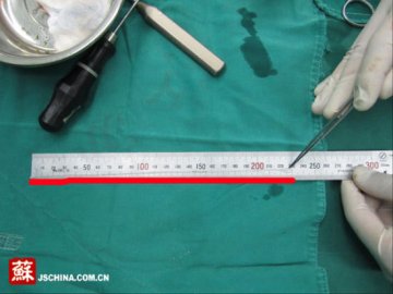 女子突发癫痫 医生从其脑部吸出23厘米长绦虫