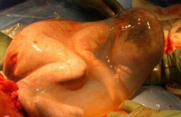 实拍剖腹产宝宝出生瞬间