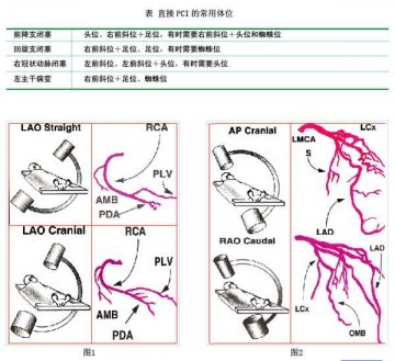 急性心肌梗死急诊PCI 血管入路与造影体位的选择