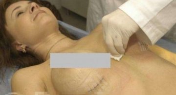 国外隆胸手术全过程实拍