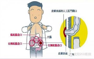 你身边有“造口人”吗？