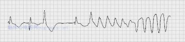 尖端扭转性室性心动过速Torsade de pointes ventricular tachycardia