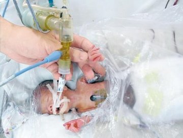 41岁产妇产下600克袖珍男婴 约手掌大小