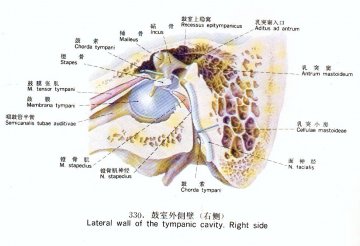 鼓室外侧壁（右侧）