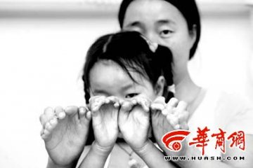 母女因家族遗传病双手均长七指