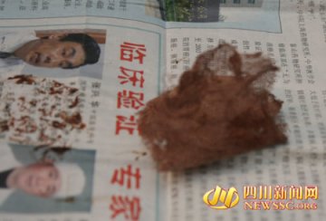 农民手术后腹藏纱布痛3年纳溪区中医院推诿或系他院所留
