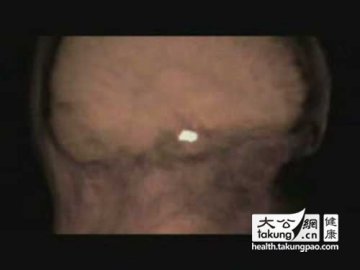 神奇的生命：实拍女性排卵真实过程