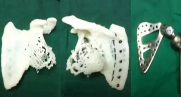深圳：首次运用3D打印技术为患者换“肩”