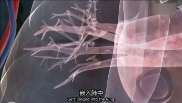 医学解读：男子腿绑香肠冒充阳物为何丧命