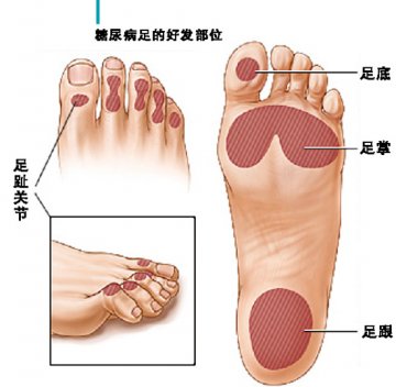 如何“拯救”糖尿病足