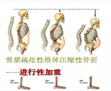 军医解析：针眼里的脊柱手术