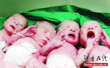 24岁孕妇自然怀孕四胞胎顺利生产