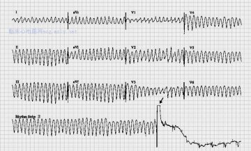 多形性室速Polymorphic Ventricular Tachycardia
