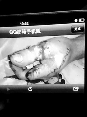 武警辽宁省总队医院医生取男子脚趾再造拇指