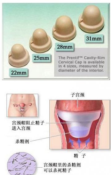 性福春节：女性新式避孕方法大全