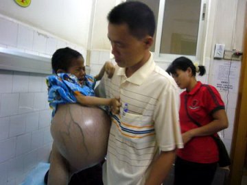 4岁女童患病腹部肿胀如鼓 网友呼吁救助