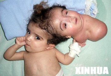 双头女婴术后脑部病毒感染死亡图