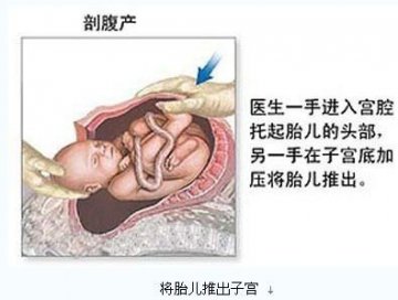 医学实录：女性剖腹产手术全过程
